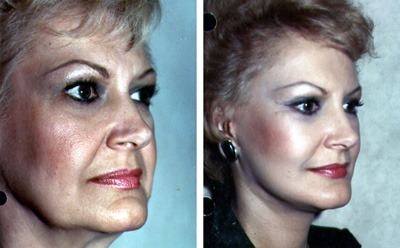 Facelift Before and After Patient 1