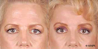 Forehead Lift Before and After Patient 1