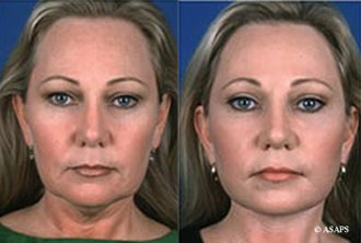 Forehead Lift Before and After Patient 2
