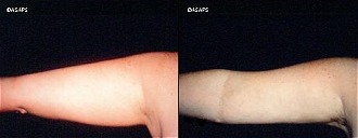 Liposuction Before and After Patient 1