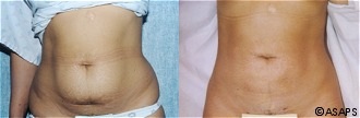 Liposuction Before and After Patient 4