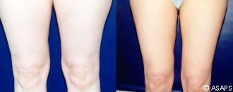 Liposuction Before and After Patient 3