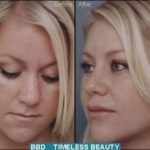 Rhinoplasty Before and After Patient 2