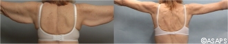 Arm Lift Before and After Patient 2