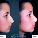 Rhinoplasty Before and After Patient 4