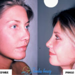 Rhinoplasty Before and After Patient 5