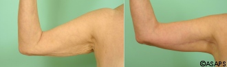 Arm Lift Before and After Patient 1